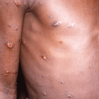 OMS: «Es posible detener a la viruela del mono» 