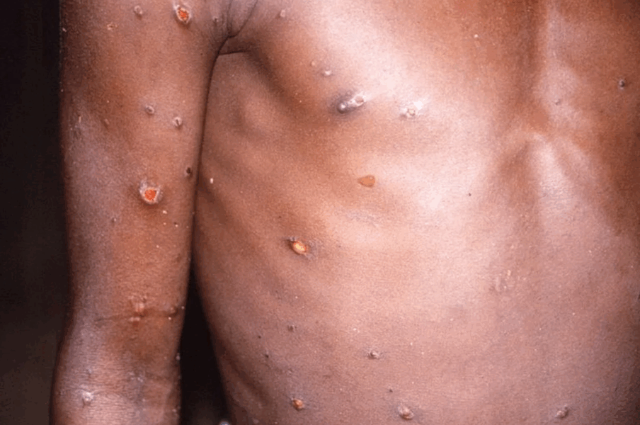 OMS: «Es posible detener a la viruela del mono» 