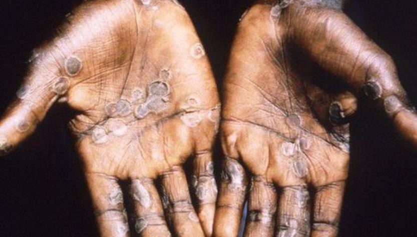 Chile: confirman tercer caso de viruela del mono