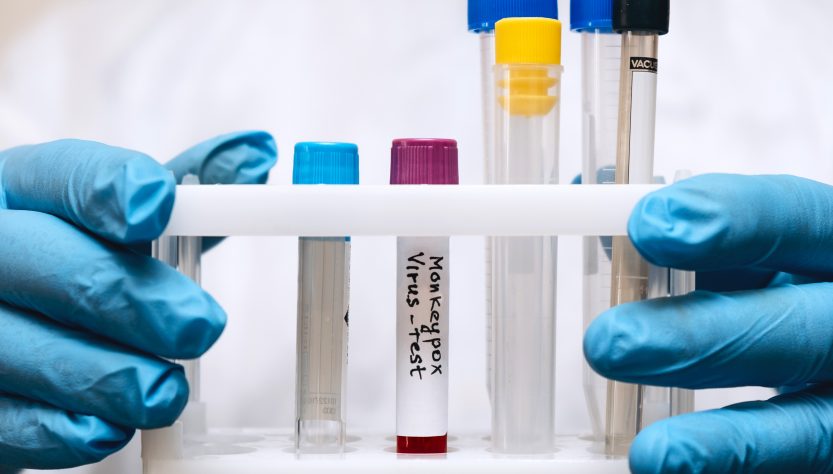 Chile: detectan el segundo caso de viruela del mono