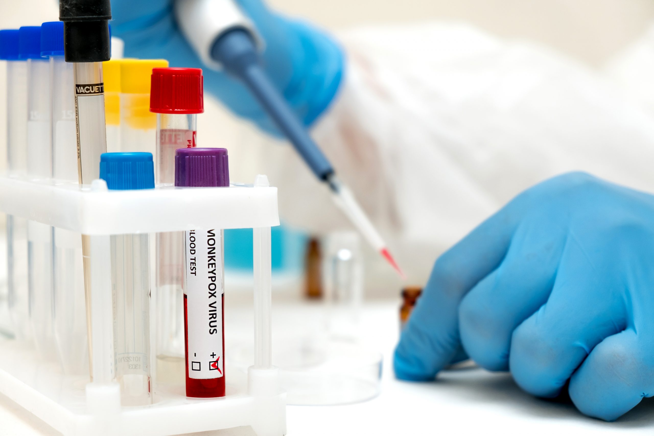 Viruela del mono: casos confirmados en América Latina