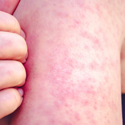 Alerta epidemiológica en México por brote de sarampión