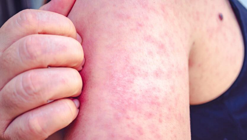 Alerta epidemiológica en México por brote de sarampión